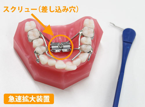 小児矯正 - さくら木歯科こども歯科（川西市多田）